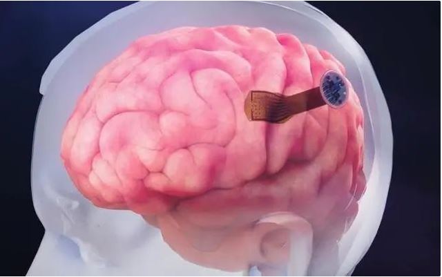 脑机接口最新科研进展以“半侵入性”方式植入大脑！(图1)