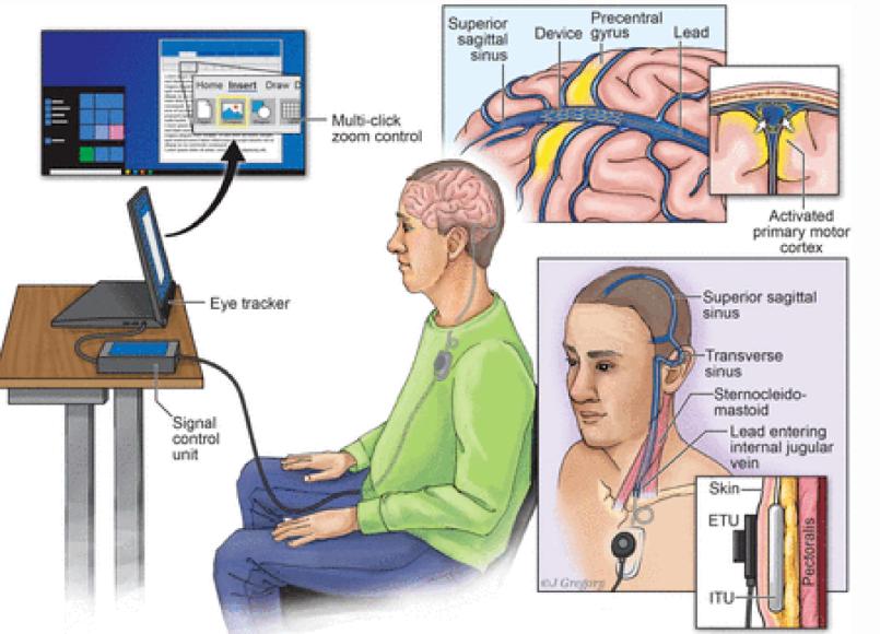 精准意念操控！中国团队破解脑机接口通用性难题距离临床应用还有多远(图1)
