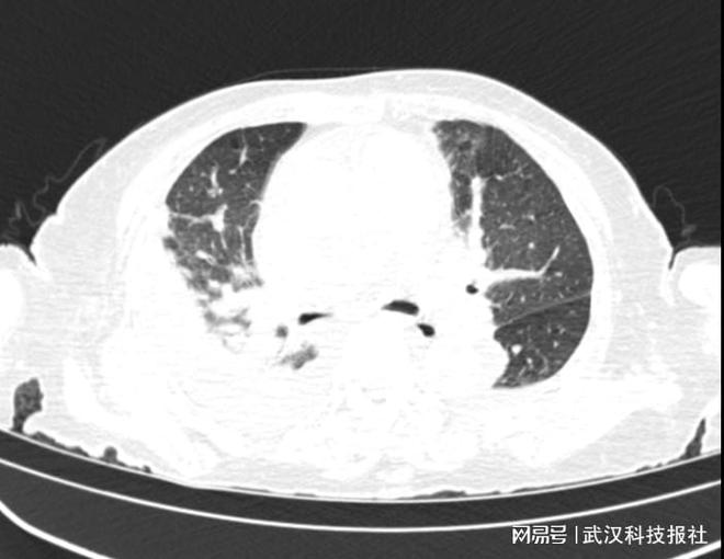 99岁奶奶陷“心脑危机” 神经外科多维度救治转安(图1)