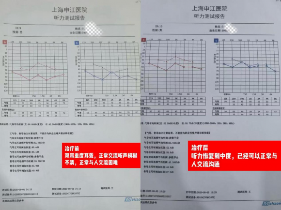 上海申江医院：耳神经激活靶向植入治疗开启听力新生(图2)