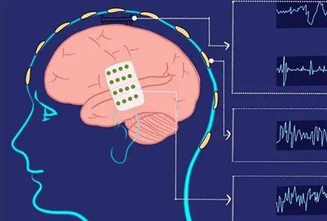 竞逐脑机接口赛道江西如何发力？(图1)