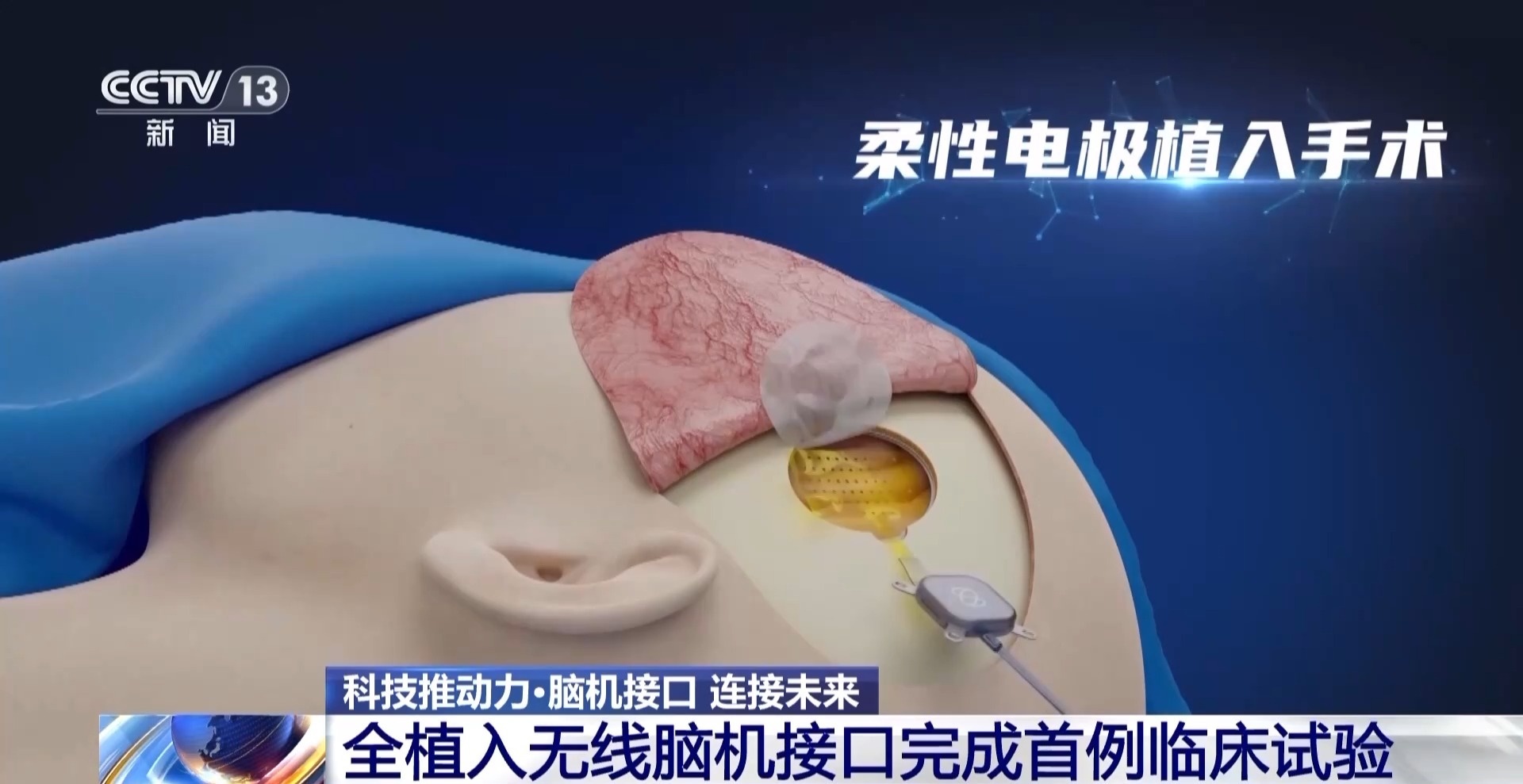 当脑机接口走进生活会为我们带来哪些新可能？(图1)