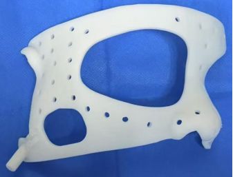 告别“凭经验”!达州市二医院开展3D打印辅助精准神经调控术(图2)