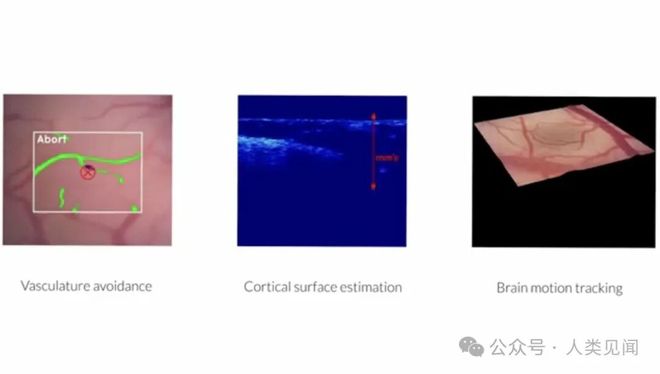 近期全球脑机接口进展：Neuralink植入21人、中国完成太空验证、超声波非侵入技术登场(图2)