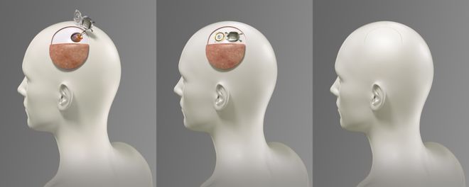 从技术竞赛到系统定义！智冉医疗发布千通道侵入式柔性脑机接口系统(图4)