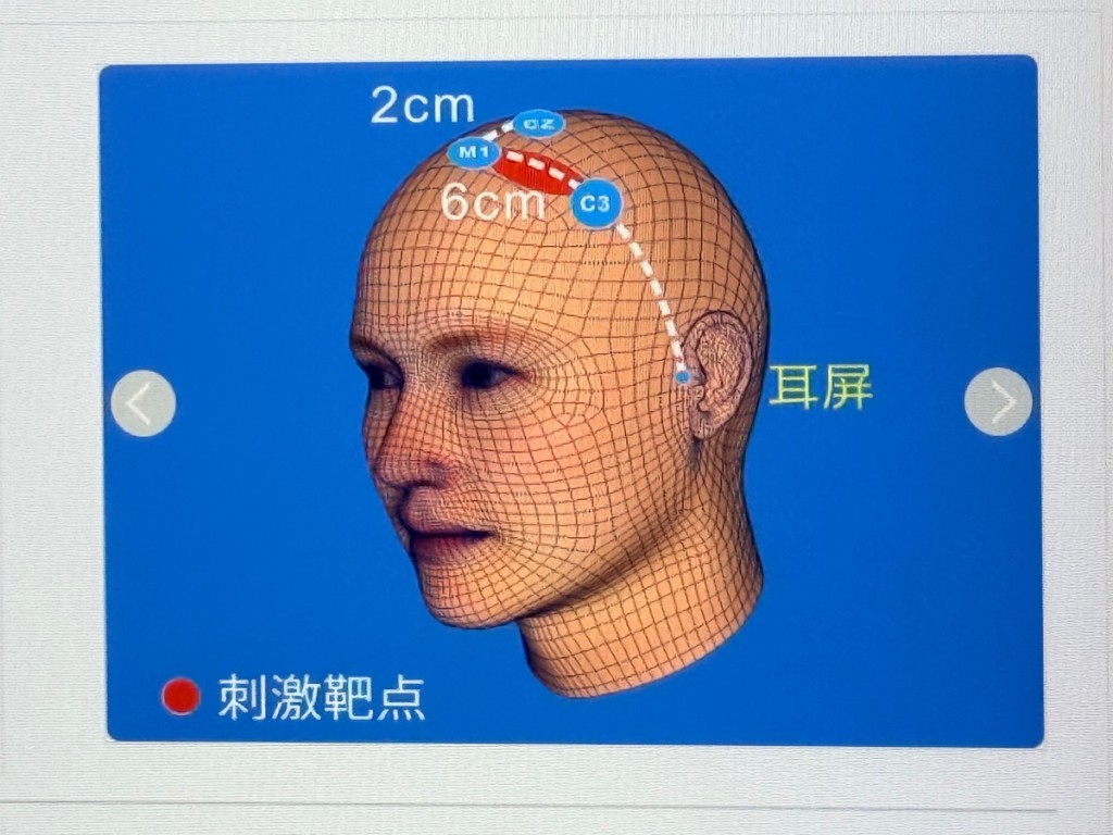 上海医生团队国际期刊发文：无创神经调控技术可治疗孤独症(图2)