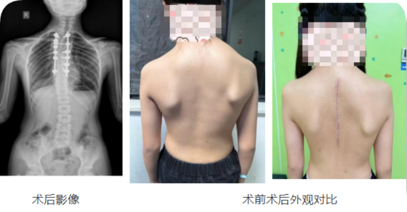 川东北首例！重度脊柱侧弯患儿在北京安贞医院南充医院挺直脊梁(图2)
